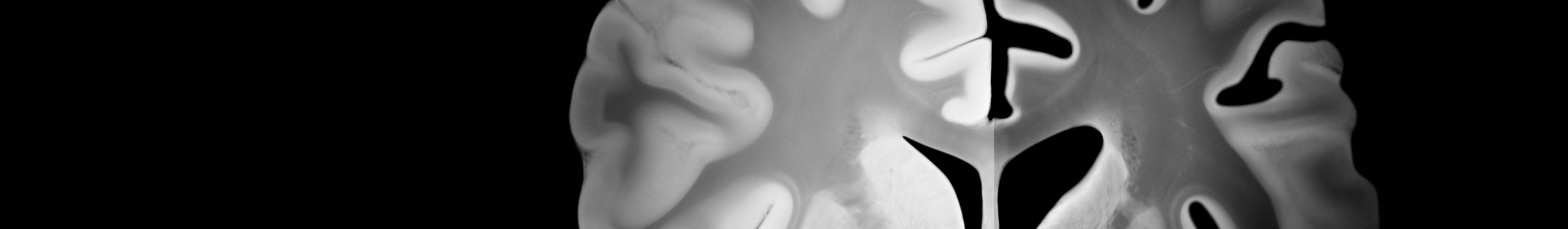 Querschnitt eines Gehirns, der die graue und weiße Substanz zeigt. Die Abbildung hebt die Struktur und Anordnung der verschiedenen Bereiche hervor, einschließlich der Furchen und Windungen. Die Darstellung dient der Veranschaulichung der anatomischen Merkmale des Gehirns.